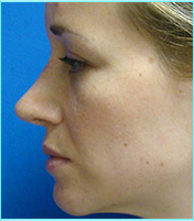 Side view before refinement of the nasal tip